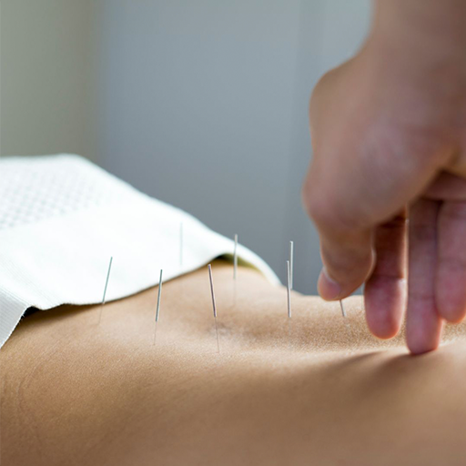 Acupuncture