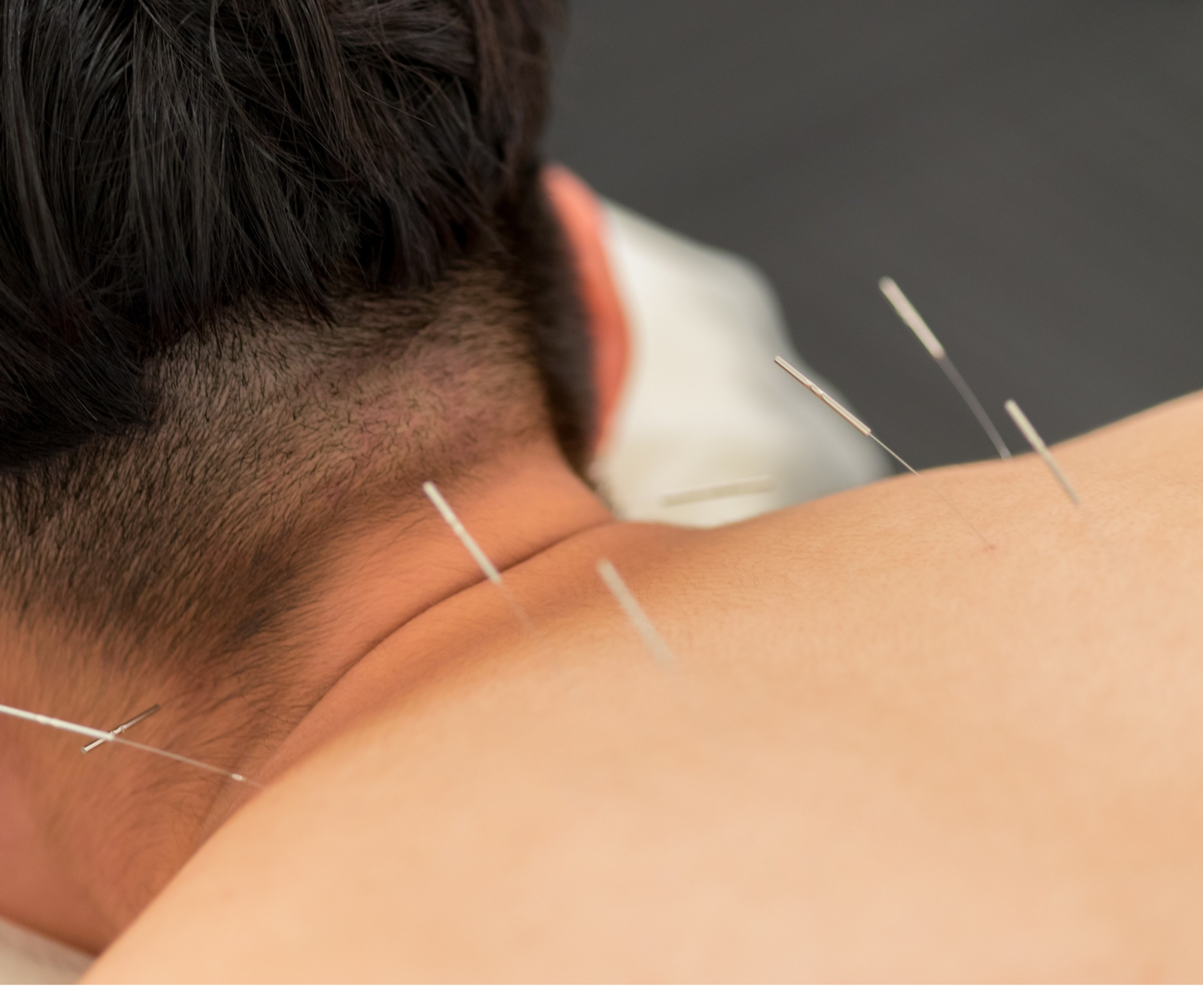 clinical acupuncture therapy
