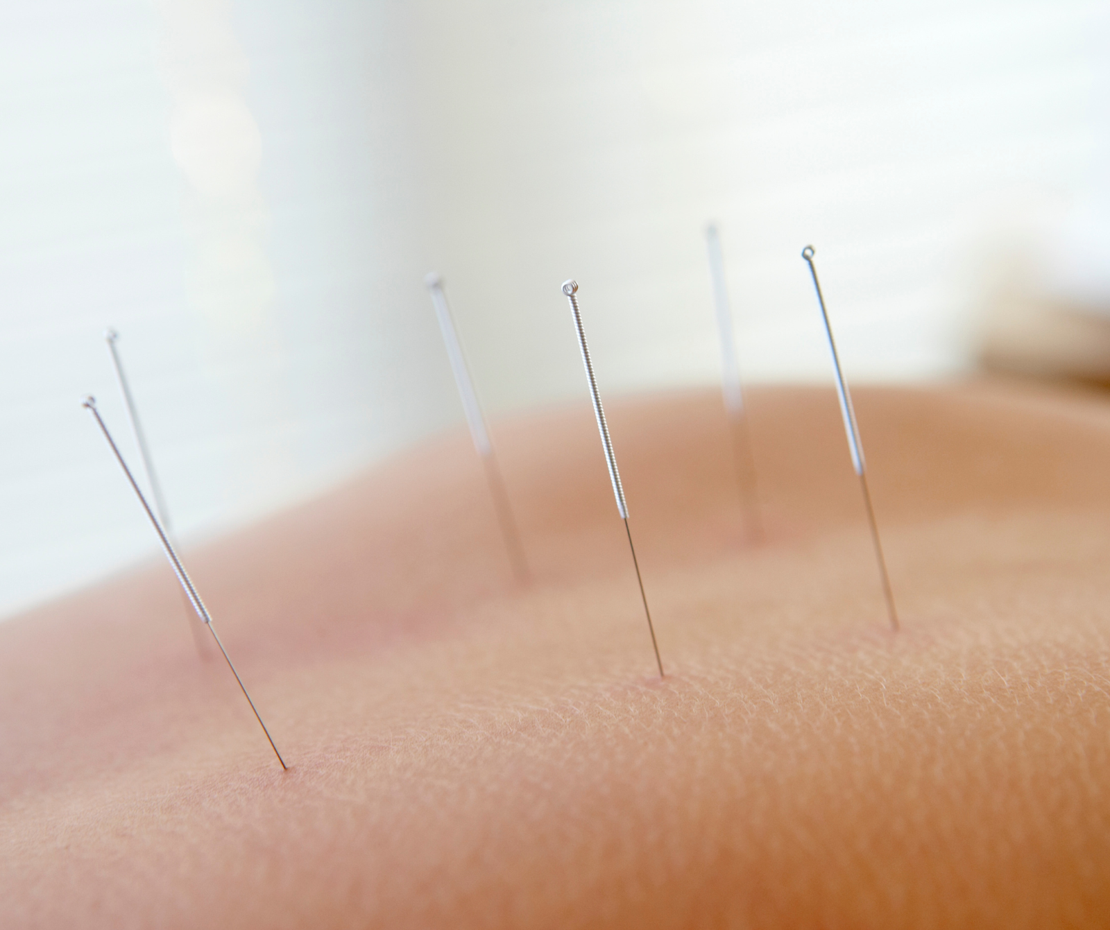 clinical acupuncture therapy