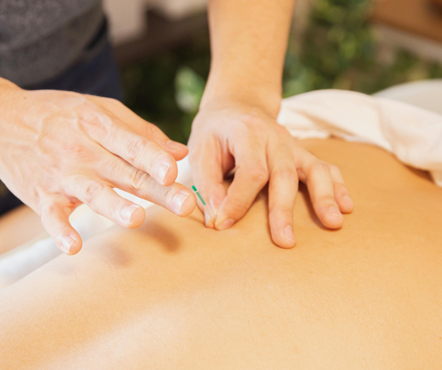 single needle acupuncture therapy