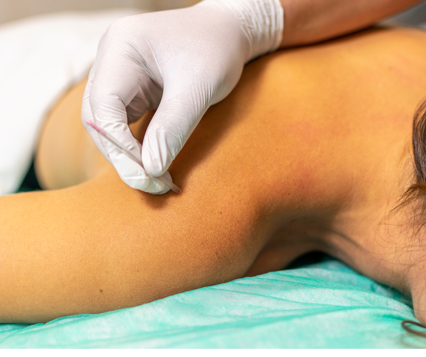 single needle acupuncture therapy