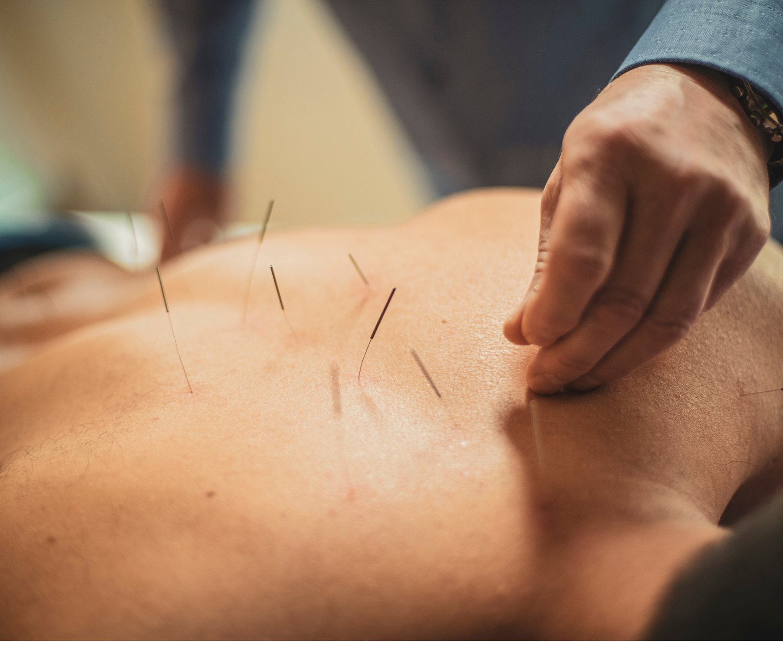 clinical acupuncture therapy