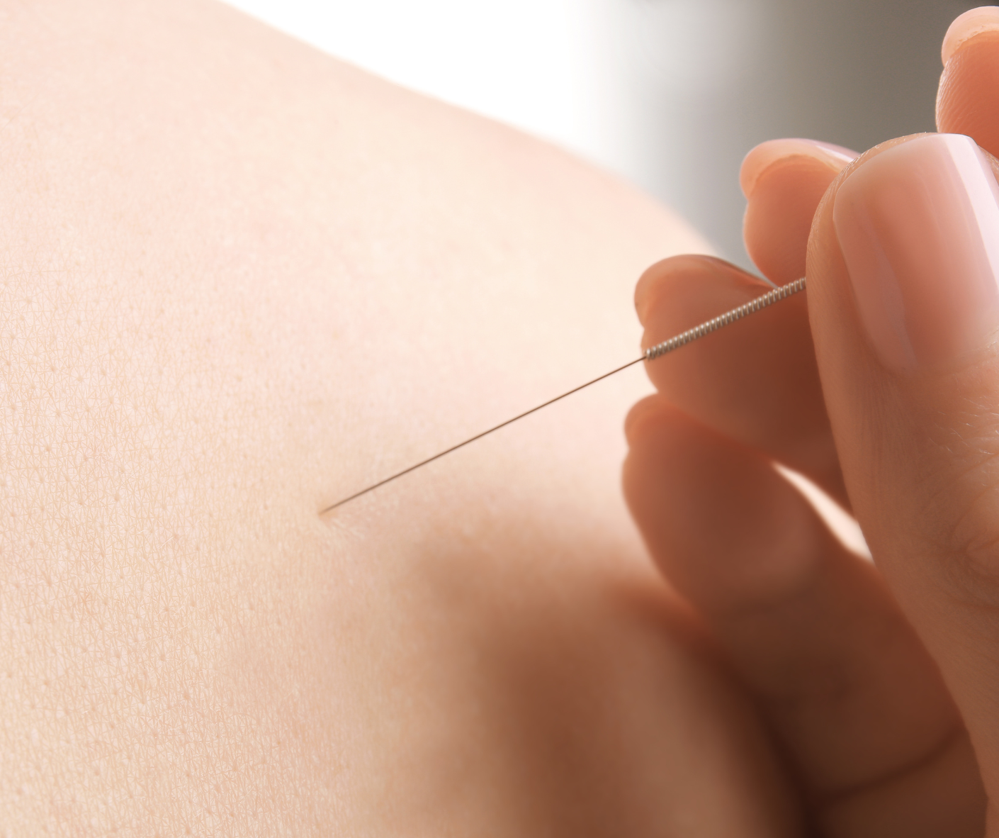 single needle acupuncture therapy