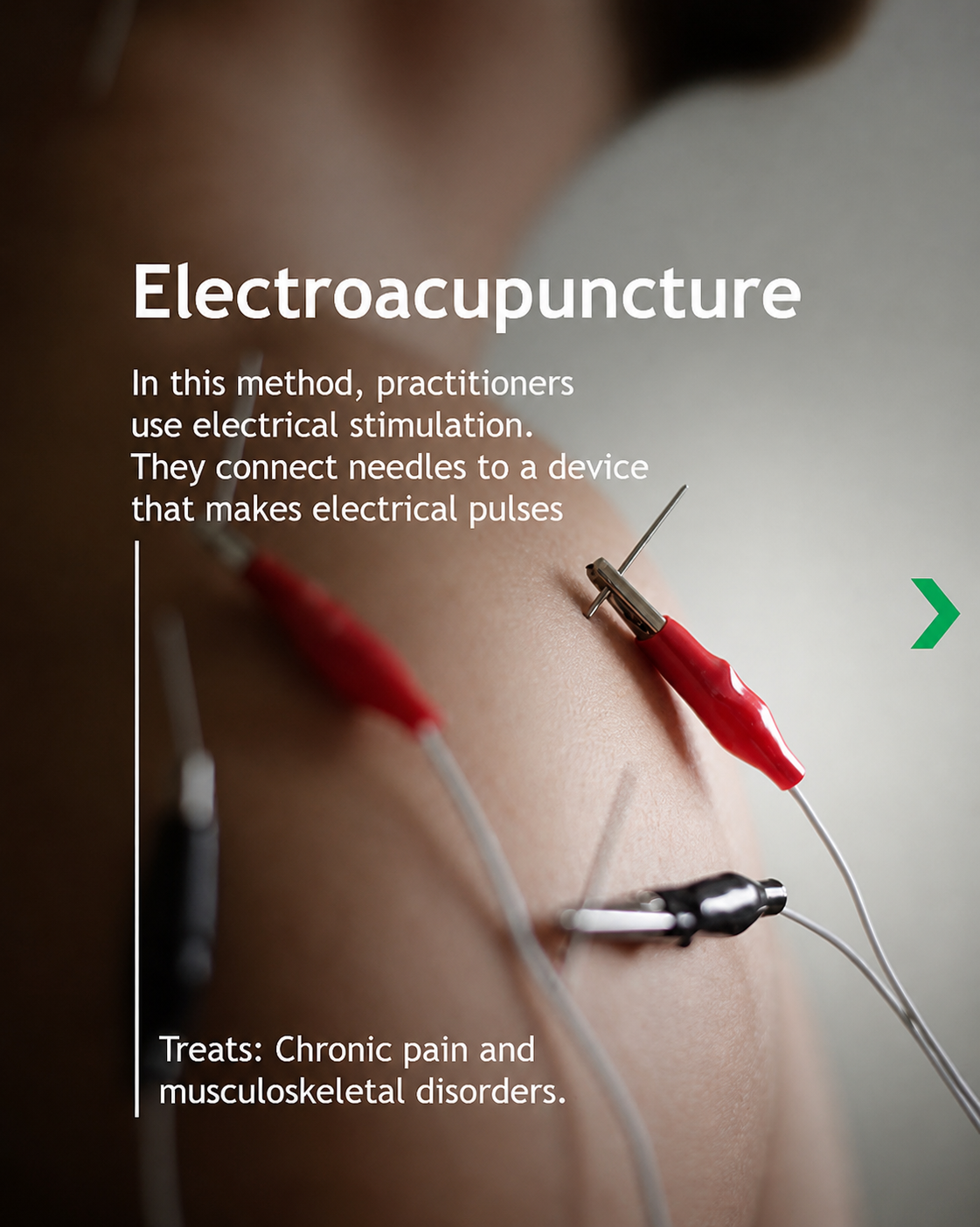 electro acupuncture